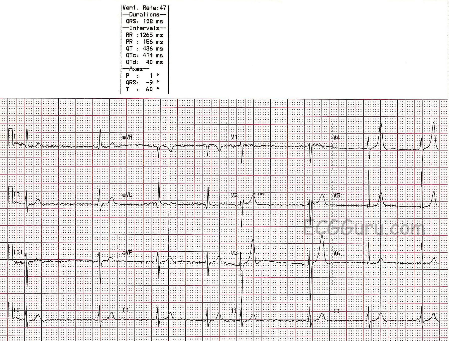 peaked t waves hyperkalemia ecg
